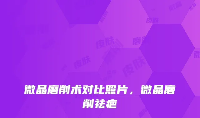 微晶磨削术对比照片，微晶磨削祛疤