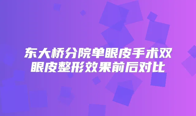 东大桥分院单眼皮手术双眼皮整形效果前后对比
