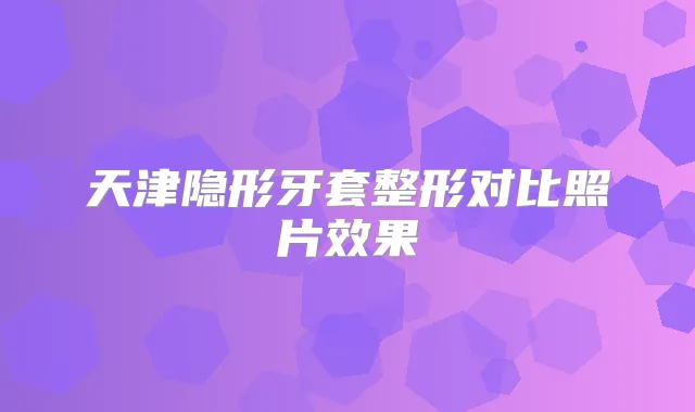 天津隐形牙套整形对比照片效果