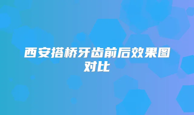 西安搭桥牙齿前后效果图对比