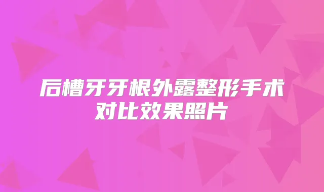 后槽牙牙根外露整形手术对比效果照片