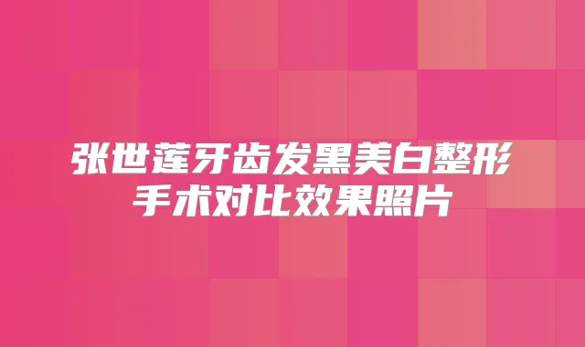 张世莲牙齿发黑美白整形手术对比效果照片